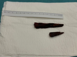 The Yule Log: Intrapulmonary Wooden Foreign Body Retained for Four Decades