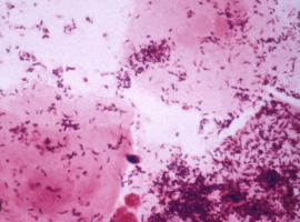 A Case Report of Pseudomonas Vaginitis: A Common Pathogen in an Uncommon Place