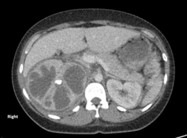 Xanthogranulomatous Pyelonephritis