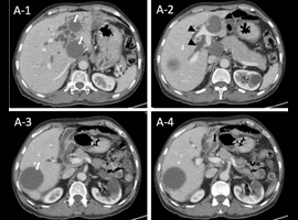 Multiple Hydatid Cysts Rupturing into the Biliary Tree