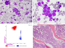 Extensive Bone Marrow Involvement by Metastatic Rhabdomyosarcoma