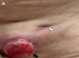 Renal Cell Carcinoma with Malignant Pleural Effusion and Chest Wall Mass