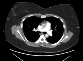 A Case of Syncope due to Atrioventricular Valve Thrombus