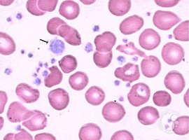 Synergistic Effect of Pegylated Interferon and Ruxolitinib in the Treatment of Resistant Essential Thrombocytosis
