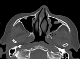 Mucormycosis Fatal Infection Case