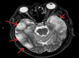 Beyond Opportunistic Infections: Unmasking CD8+ Encephalitis in Virologically Suppressed HIV Patient