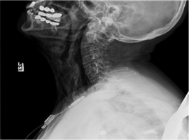 Subcutaneous Emphysema after Pacemaker Insertion