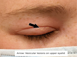 When is a Stye not a Stye