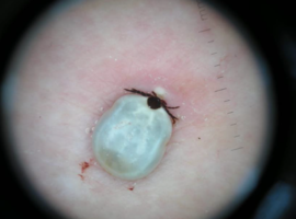 Erythema Migrans and Tick Bite