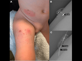 Skin Complications with Perpendicular Placement of Insulin Infusion Catheters in Children