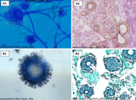 Influenza-Associated Pulmonary Aspergillosis: Description of a Case