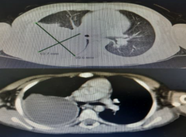 Massive Pulmonary Hydatid Cyst in a 6-Year-Old Boy