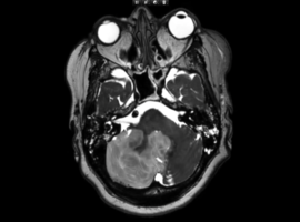Space-Occupying Cerebellar Infarction: Intraoperative Visualization of Raised Intracranial Pressure and Cerebellar Tissue Prolapse