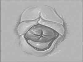 Labial Adhesions - Prepubertal Alert