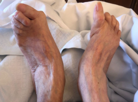 Joint Deformities in Rheumatoid Arthritis