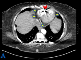 Hole in Heart: An Unexpected Cause of Pleuritic Chest Pain