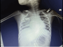 A Multisystem Inflammatory Syndrome in Children MIS-C with Kidney Involvement: A Case Report