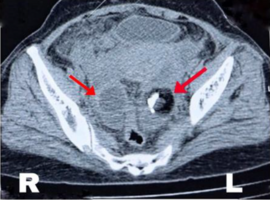 Laparoscopic Management of Acute and Chronic Tubo-ovarian Abscess in a Rural Setup: A Case Series