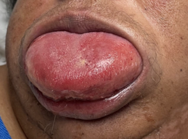 Acute Onset Macroglossia After Traumatic Intubation