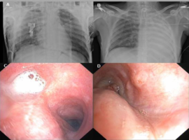 Traumatic Bronchial Rupture - A Clinical Case Report